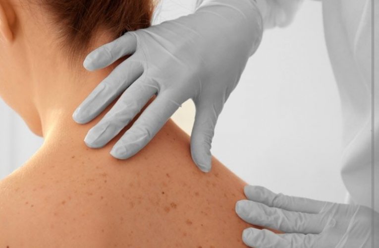 In programma Screening Dermatologia gratuito per tutti i soci 27.03.2022